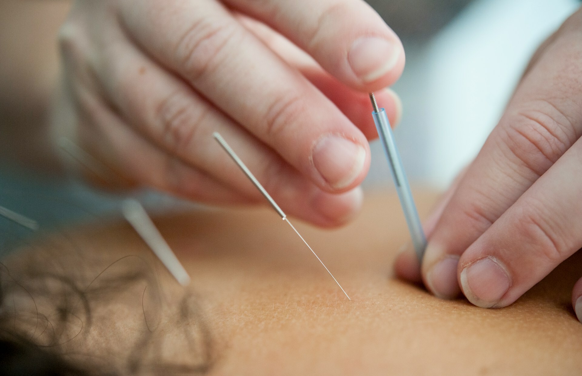 Spa Oasis Acupuncture Packages – A Smarter Way to Heal