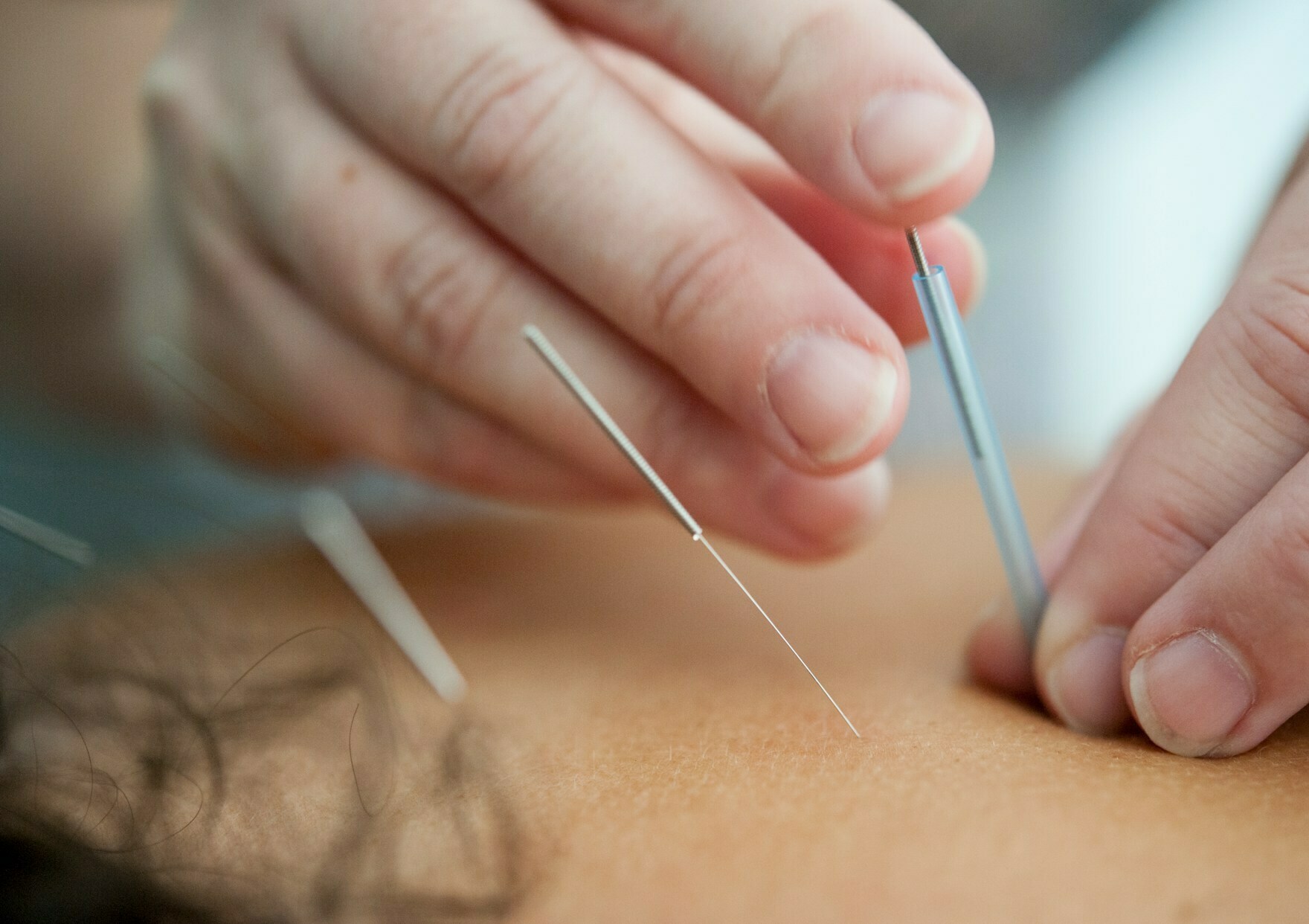 Spa Oasis Acupuncture Packages – A Smarter Way to Heal